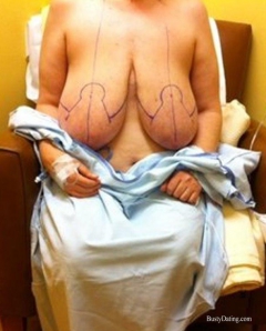 Busty Breast Reductions - Set 18 - N